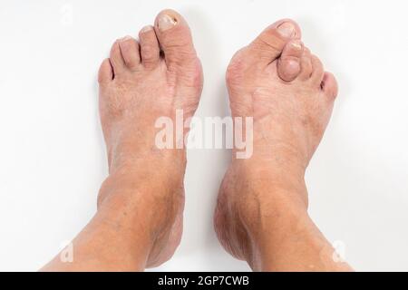 I piedi di una donna con stadio avanzato bunion (abductus alluce valgo) Foto Stock