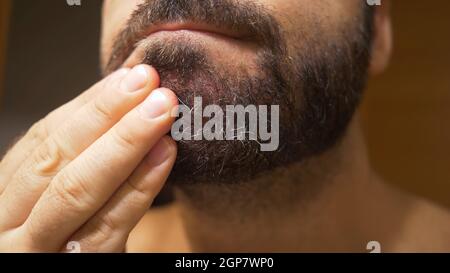 Particolare del mento dell'uomo con dermatite seborroica nella zona della barba. La pelle secca si spela e provoca prurito e forforfora. Foto Stock