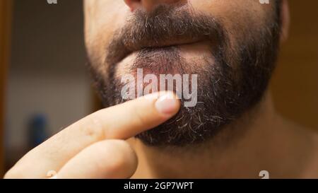 Particolare del mento dell'uomo con dermatite seborroica nella zona della barba. La pelle secca si spela e provoca prurito e forforfora. Foto Stock