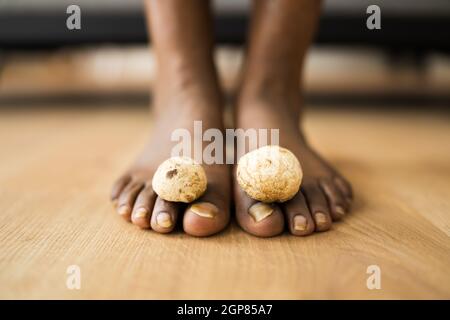 Fungo funghi tra Toenail. Piedi e funghi puzzolenti Foto Stock