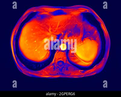 Sezione trasversale addome MRI scan di 60 anno vecchio paziente di sesso maschile. Questo paziente soffre di una pietra di rene Foto Stock