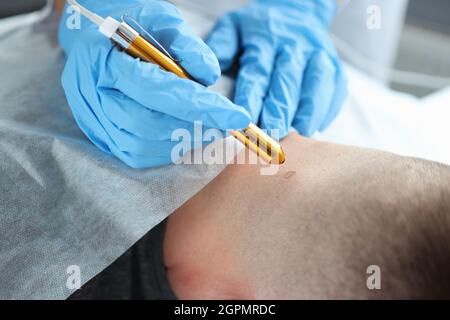 Rimozione laser di una talpa sul collo dell'uomo nel salone di bellezza Foto Stock