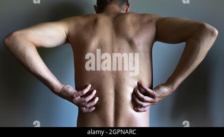 Uomo che soffre di una malattia dermatologica autoimmune incurabile della pelle. Eruzione cutanea infiammata in tutto il corpo. Macchie di diverse dimensioni Foto Stock