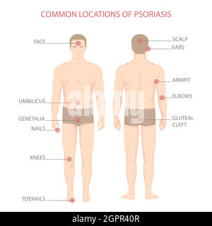 psoriasi, malattia della pelle del corpo umano Illustrazione Vettoriale