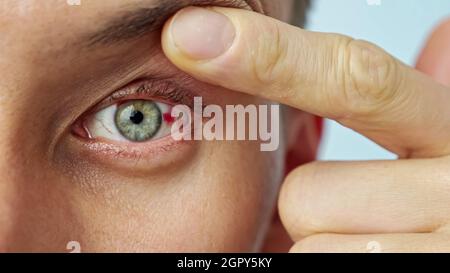 primo piano dell'occhio dolorante di un uomo, allungato con le dita Foto Stock