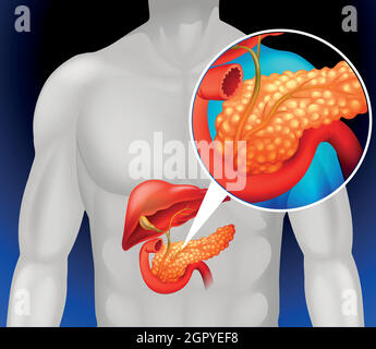 Ridurre il pancreas umano Illustrazione Vettoriale