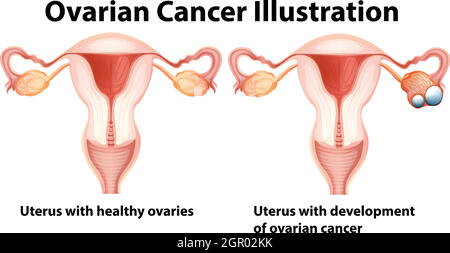 Ovaie sane e malsane in donna Illustrazione Vettoriale