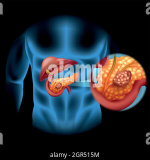 Diagramma del cancro del pancreas nel corpo umano Illustrazione Vettoriale