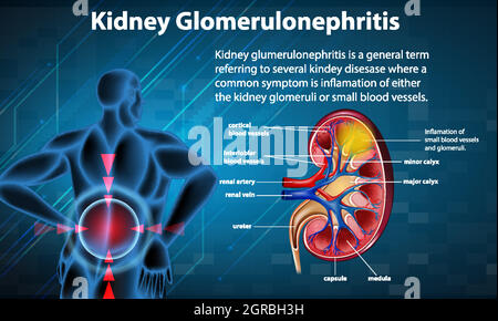 Infografica medica della glomerulosclerosi renale Illustrazione Vettoriale