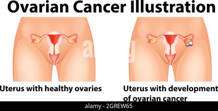 Diagramma che mostra il cancro ovarico nell'uomo Illustrazione Vettoriale