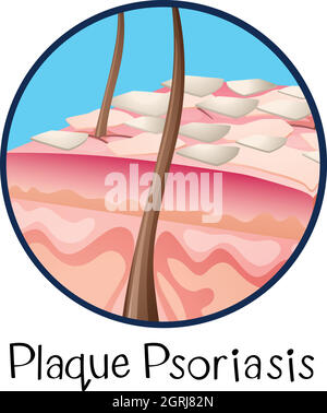 Una psoriasi a placche di anatomia umana Illustrazione Vettoriale