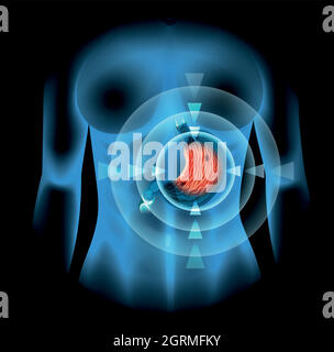 Diagramma dell'ulcera dello stomaco in donna Illustrazione Vettoriale