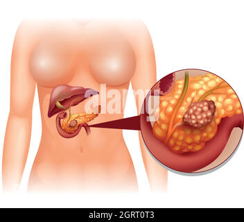 Cancro del pancreas in donna Illustrazione Vettoriale