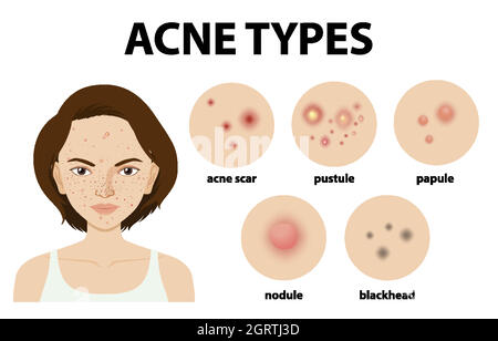 Tipi di acne sulla pelle o pimples Illustrazione Vettoriale