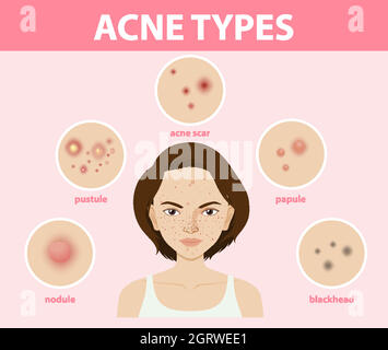 Tipi di acne sulla pelle o pimples Illustrazione Vettoriale