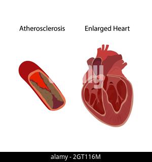 Aterosclerosi e cuore ingrandito, illustrazione Foto Stock