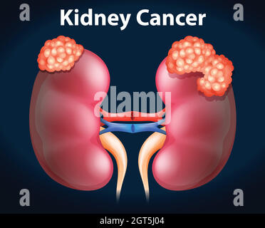 Diagramma che mostra il cancro ai reni Illustrazione Vettoriale