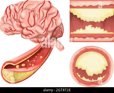 Una condizione cerebrale su sfondo bianco Illustrazione Vettoriale