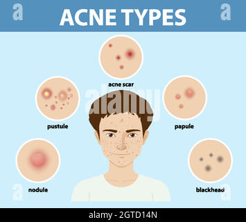 Tipi di acne sulla pelle o pimples Illustrazione Vettoriale