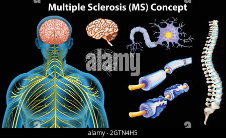Diagramma che mostra il concetto di sclerosi multipla Illustrazione Vettoriale