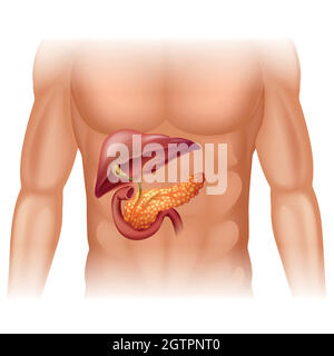 Diagramma del cancro del pancreas in dettaglio Illustrazione Vettoriale