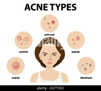 Tipi di acne sulla pelle o pimples Illustrazione Vettoriale