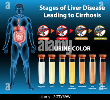 Stadi di malattia epatica che portano alla cirrosi Illustrazione Vettoriale