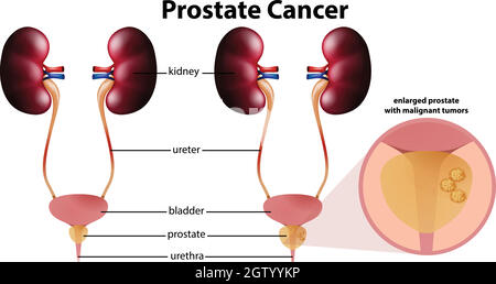 Cancro della prostata su sfondo bianco Illustrazione Vettoriale