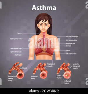 Confronto tra polmone sano e polmone asmatico Illustrazione Vettoriale
