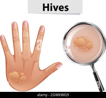 Un vettore di orticaria sulla pelle umana Illustrazione Vettoriale