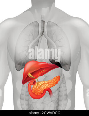 Cancro del pancreas nell'uomo Illustrazione Vettoriale