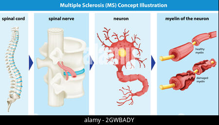 Diagramma che mostra il concetto di sclerosi multipla Illustrazione Vettoriale