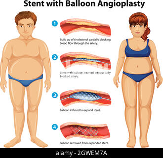 Stent con angioplastica a palloncino Illustrazione Vettoriale