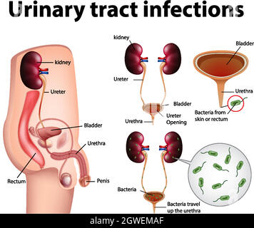 Illustrazione informativa delle infezioni del tratto urinario Illustrazione Vettoriale