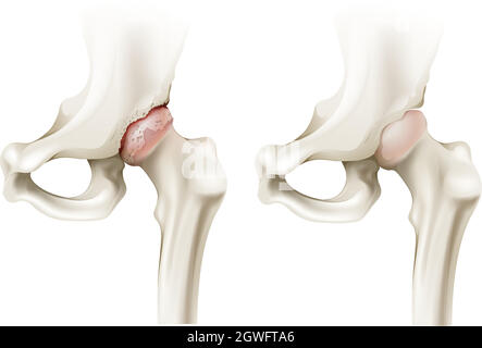 Artrite dell'anca Illustrazione Vettoriale