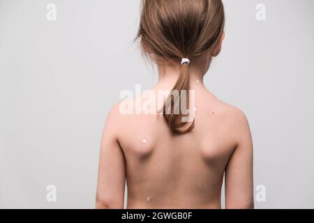 La parte posteriore di una bambina con varicella spalmato di unguento bianco. Vista posteriore. Foto Stock