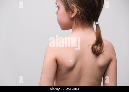 La parte posteriore di una bambina con varicella spalmato di unguento bianco. Vista posteriore. Foto Stock