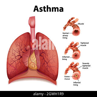 Confronto tra polmone sano e polmone asmatico Illustrazione Vettoriale