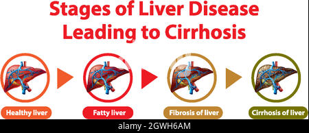 Stadi di malattia epatica che portano alla cirrosi Illustrazione Vettoriale