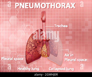 Illustrazione informativa di pneumotorace Illustrazione Vettoriale
