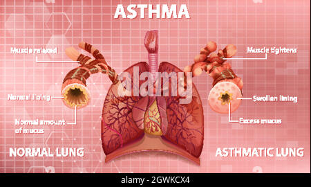Confronto tra polmone sano e polmone asmatico Illustrazione Vettoriale