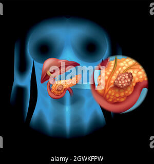 Diagramma del cancro del pancreas in dettaglio Illustrazione Vettoriale