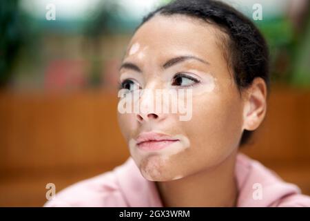 Donna nera afroamericana con pigmentazione vitiligina problema della pelle interna felpa con cappuccio rosa vestita primo piano ritratto pensivo nero pensiero femminile informazioni su Foto Stock