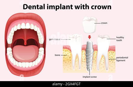 Impianto dentale con vettore corona Illustrazione Vettoriale