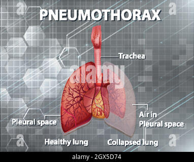 Illustrazione informativa di pneumotorace Illustrazione Vettoriale