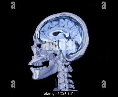 Un fosca del cranio 3D che mostra il cervello all'interno del cranio. . Foto Stock