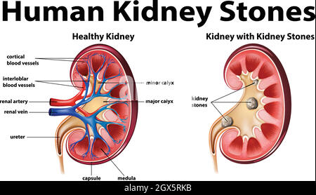 Diagramma anatomico umano con calcoli renali Illustrazione Vettoriale