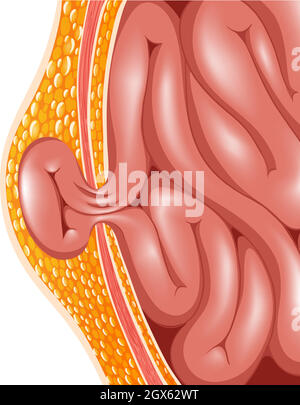 Ernia Illustrazione Vettoriale