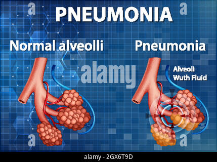 Confronto di alveoli sani e polmonite Illustrazione Vettoriale