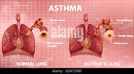 Confronto tra polmone sano e polmone asmatico Illustrazione Vettoriale